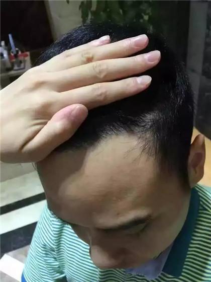 发际线高照片,探寻个性魅力新风尚